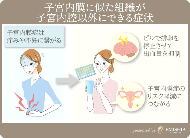 子宮内膜症とは