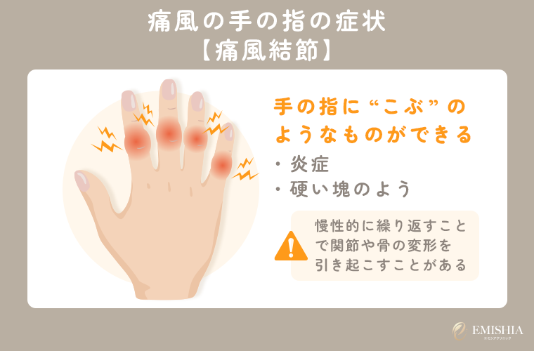 手の指に痛風結節が起こった場合の症状