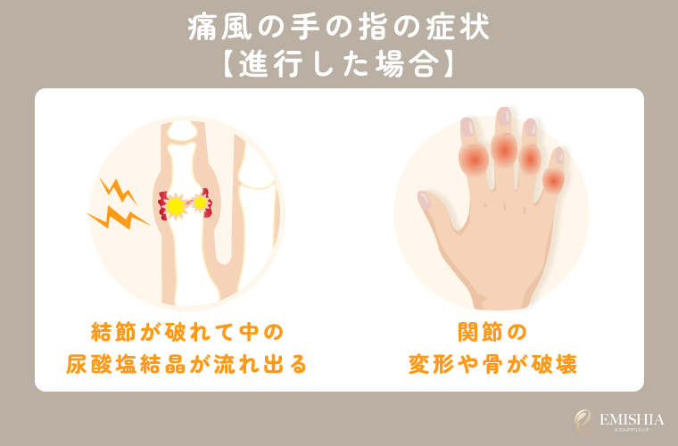 手の指の痛風が進行した場合の症状