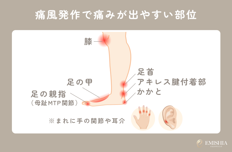 痛風の痛みが出やすい部位