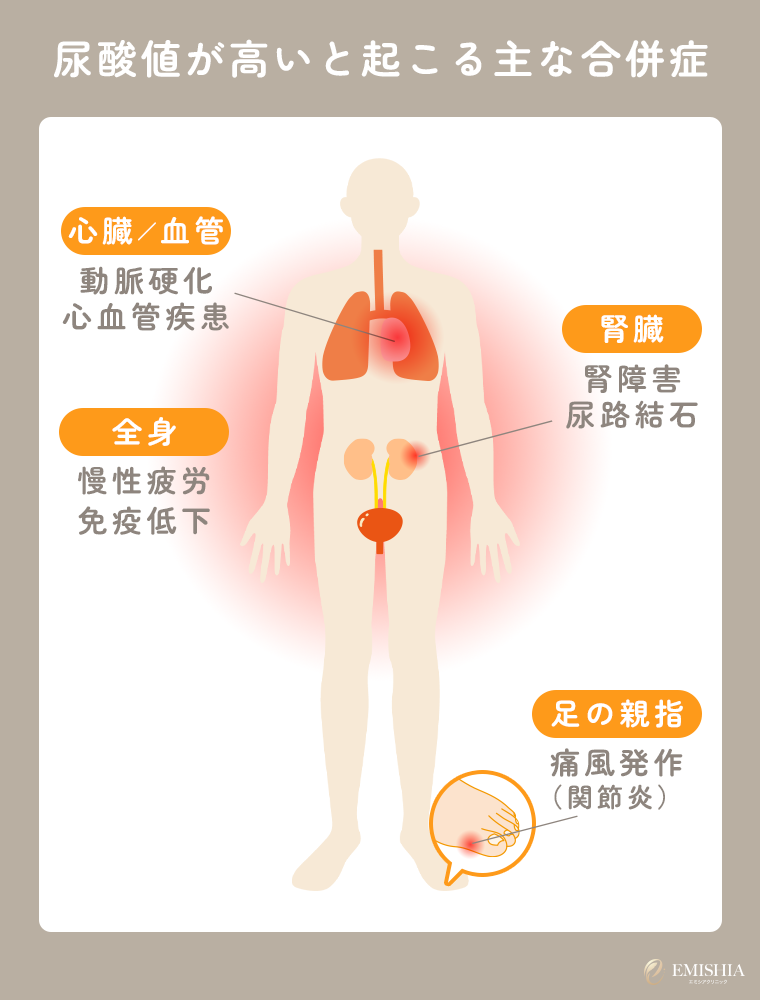 尿酸値が高いと起こりやすい主な合併症